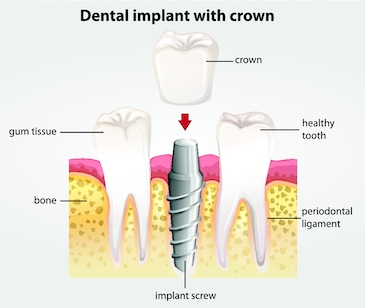 dental implant diagram