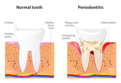 side by side of a normal tooth and gums and one with gum disease