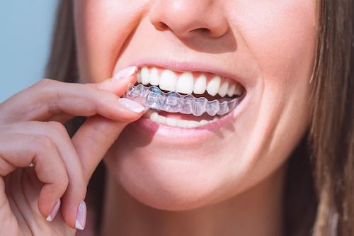 woman using invisalign in etobicoke