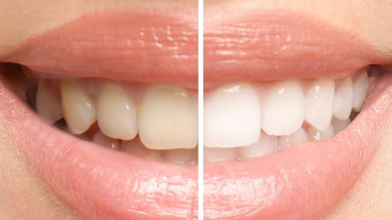 side by side of person's smile before and after teeth whitening showing a bright smile on the right