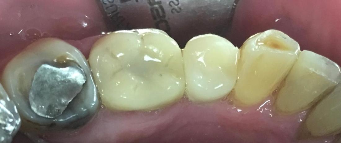 After Implant supported crown replaced a missing tooth