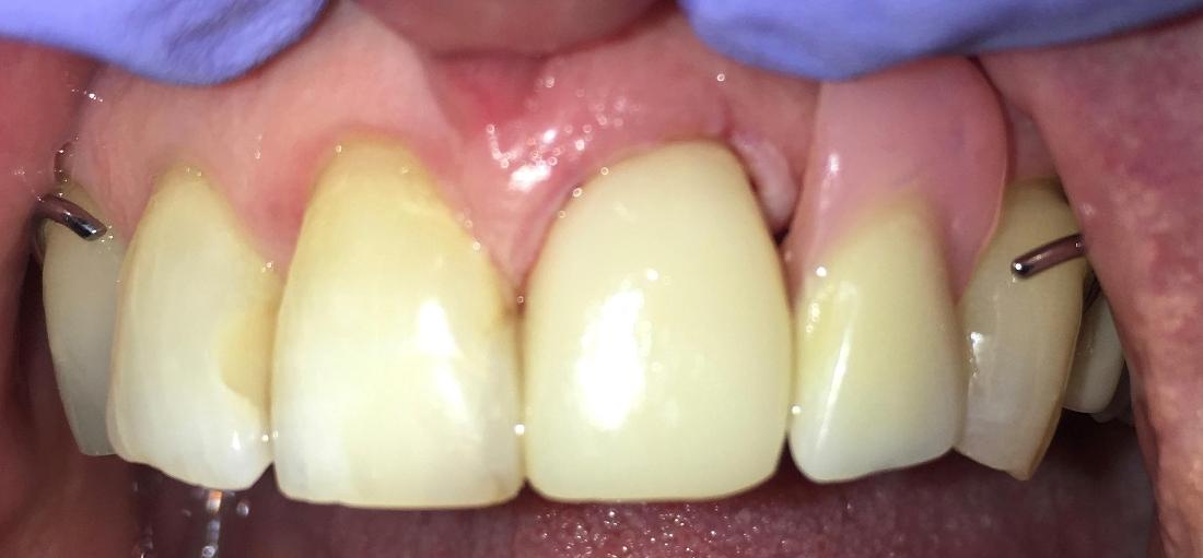 After Emax crown repaired broken front tooth