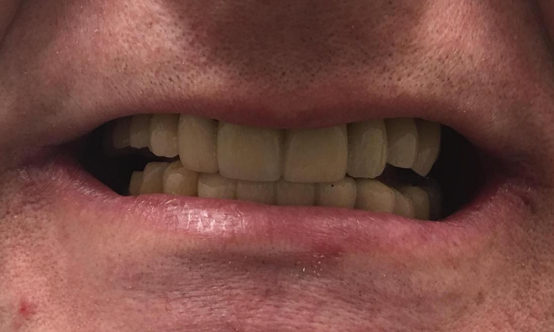 After Dental implant replaced missing front tooth