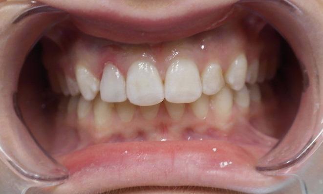 Brightened front teeth after restoration