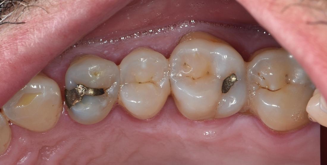 Teeth with silver restorations before new fillings