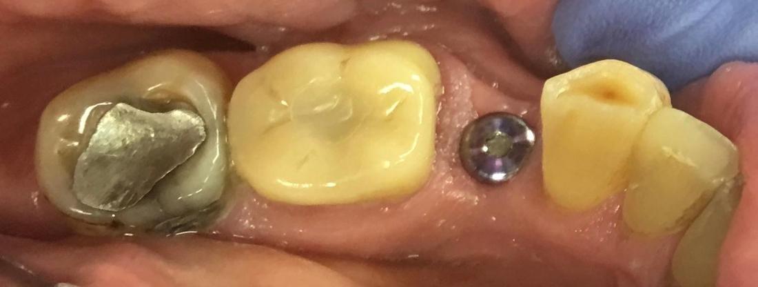 Missing back tooth before implant and crown