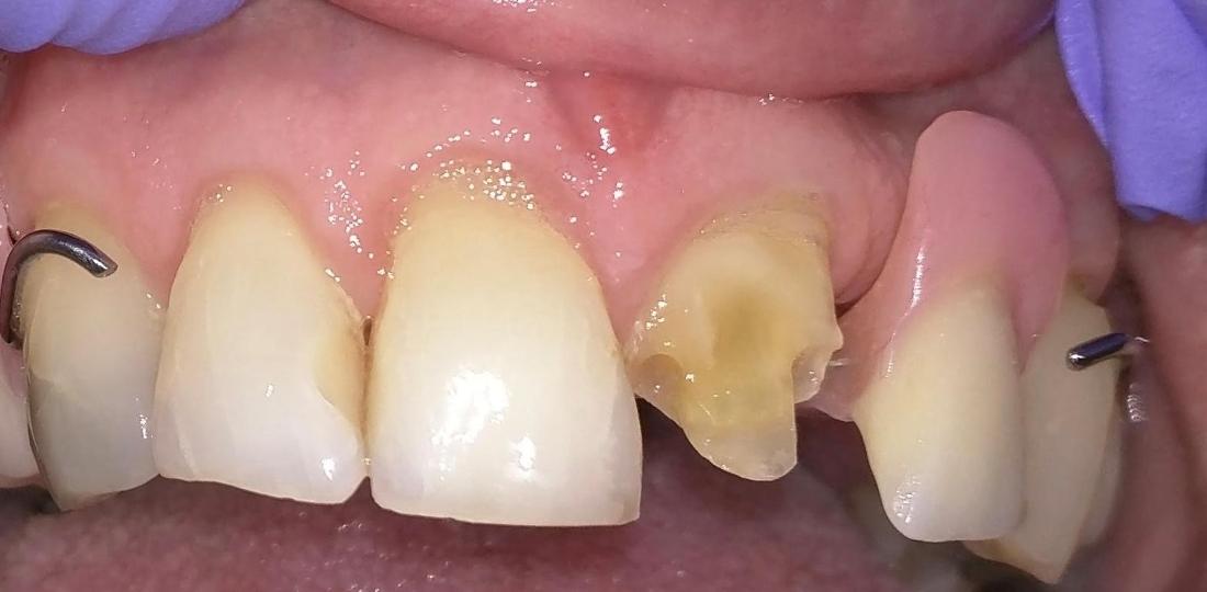 Broken front tooth before dental crown