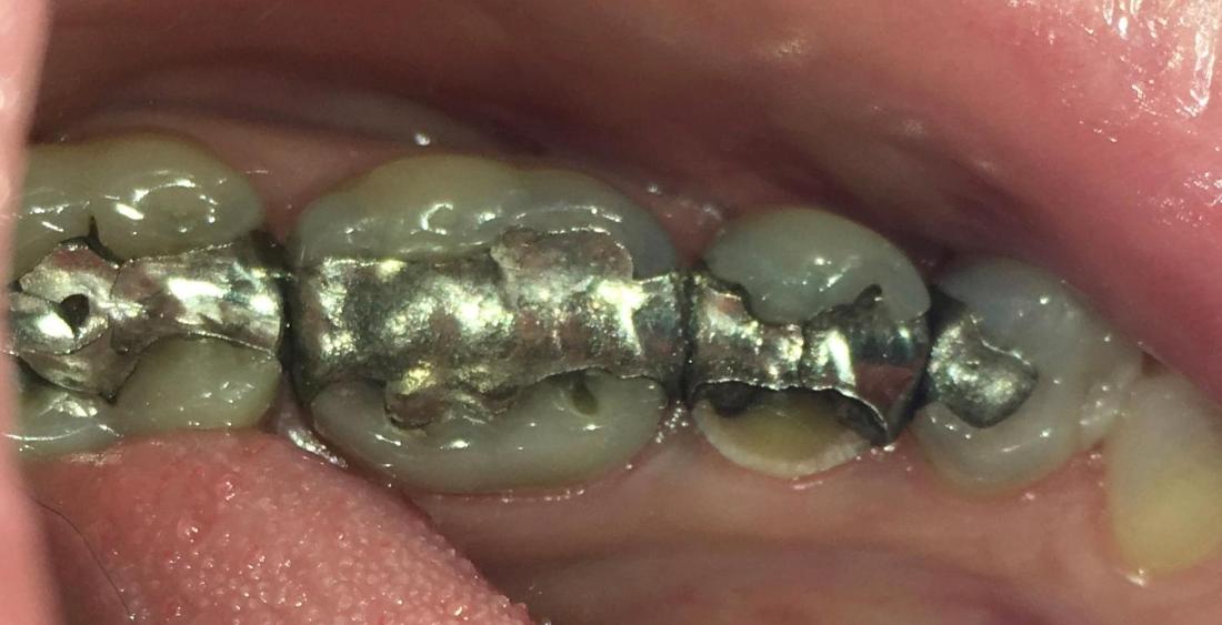 Old metal crowns before emax crowns in etobicoke