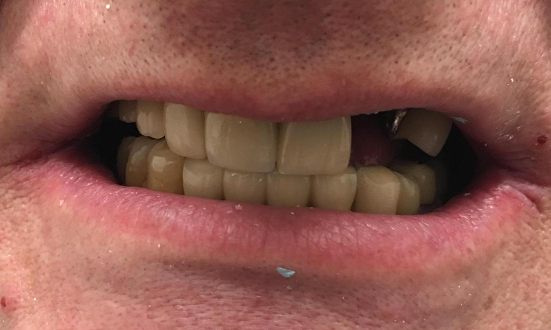 Missing front tooth before implants