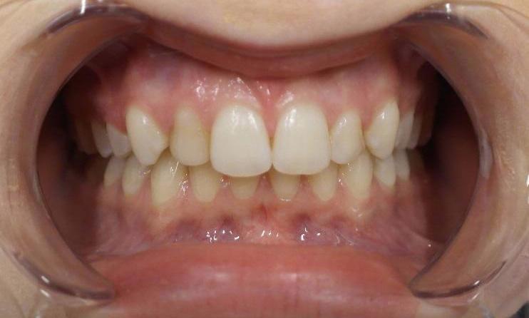 Discoloured Teeth before bonding