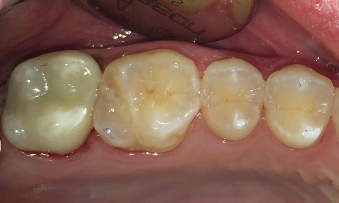 After Porcelain crowns replaced old silver fillings