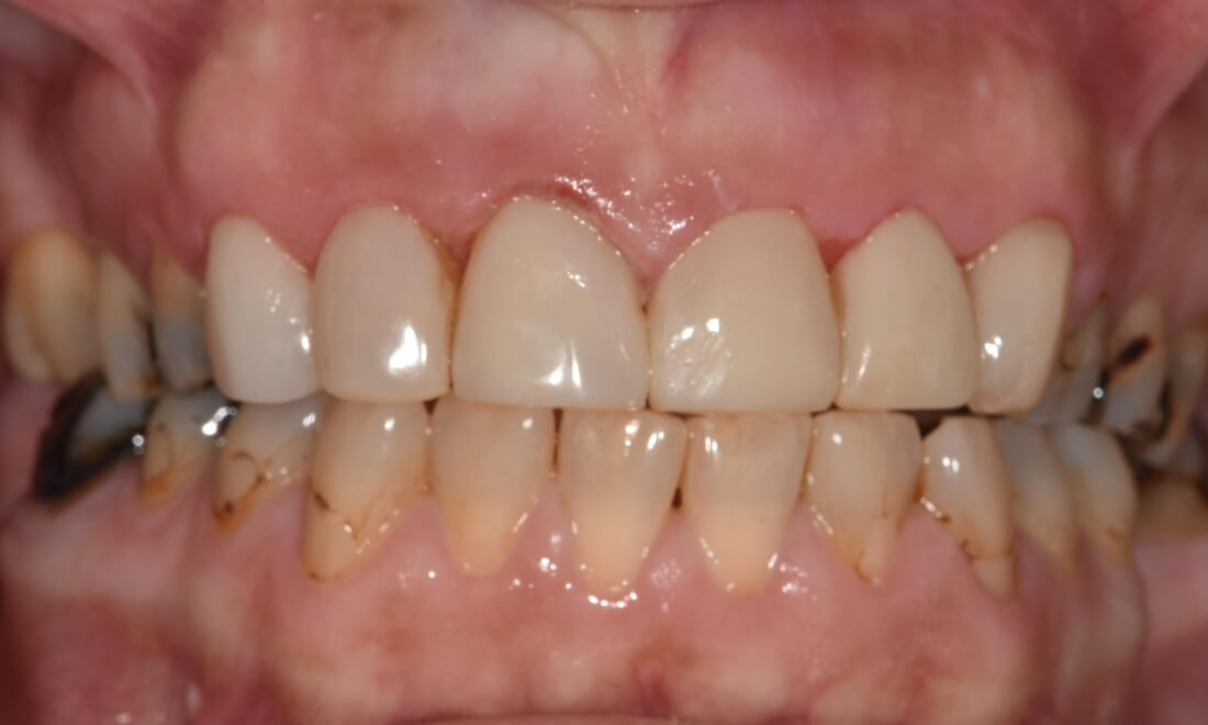 front teeth after veneers