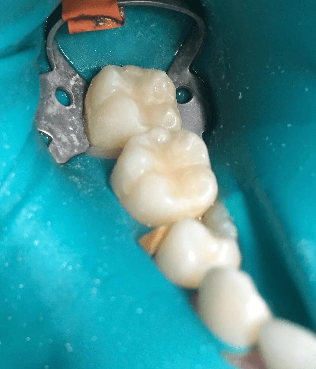 Back teeth after fillings