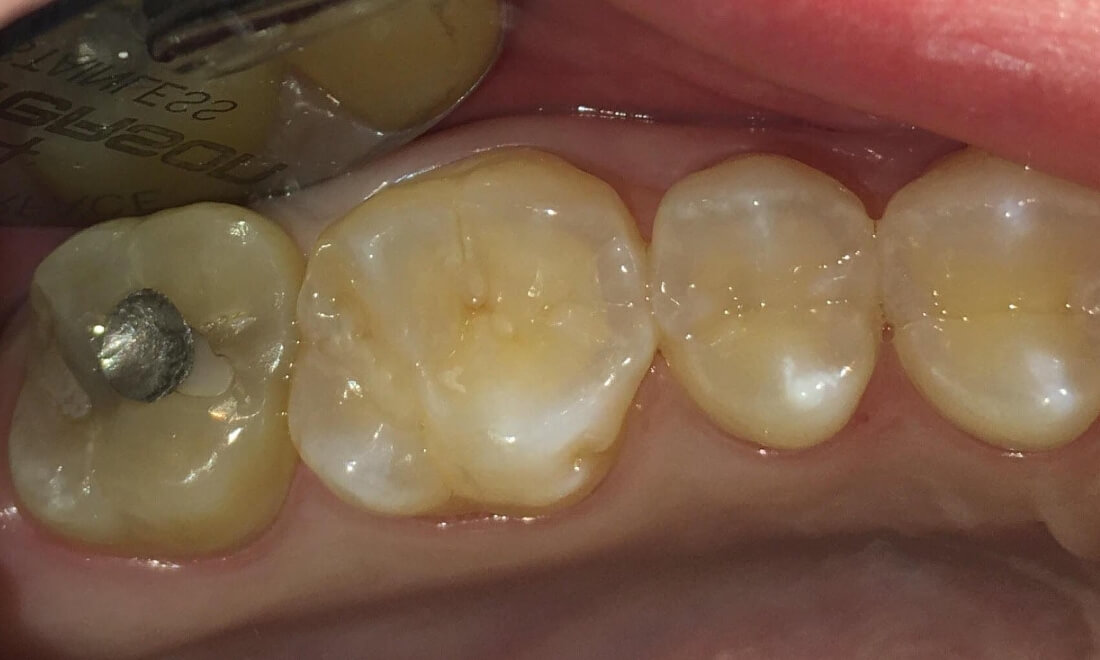 Four back teeth with one having a silver filling | Toronto Lakeshore Dental