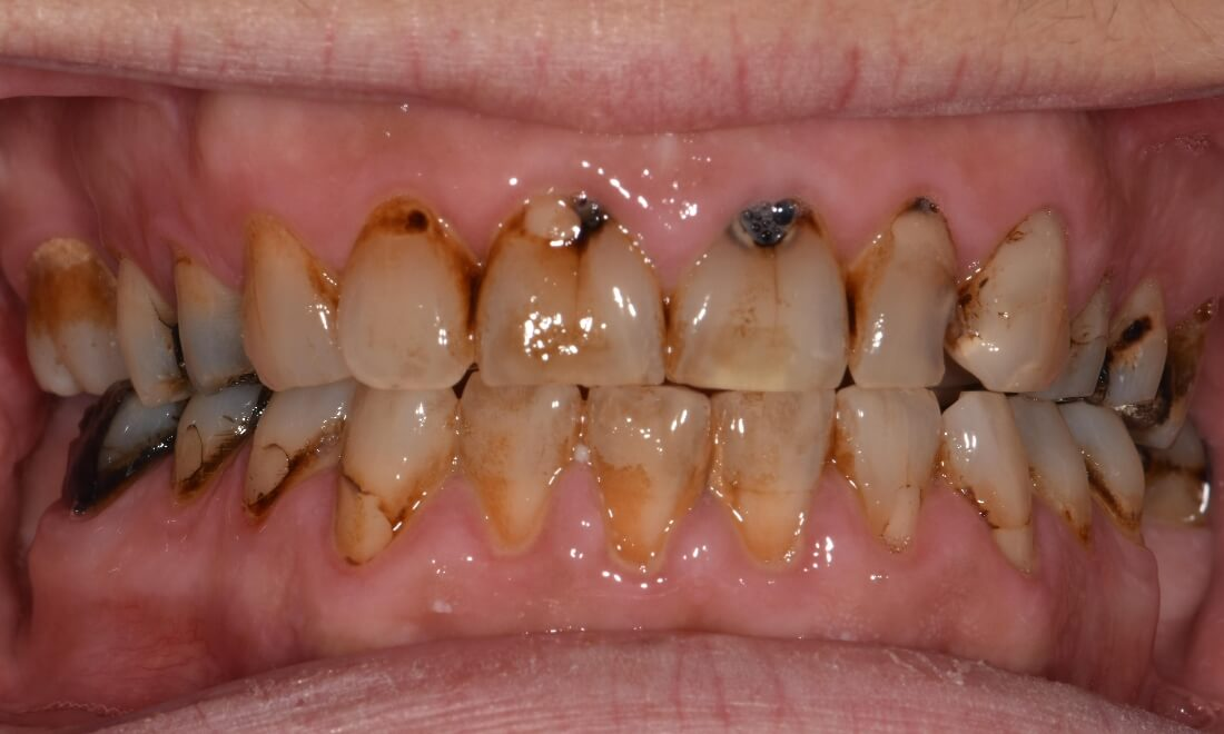 Decay around front teeth of patient before veneers