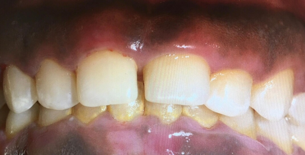 Short front teeth before crown lengthening in toronto