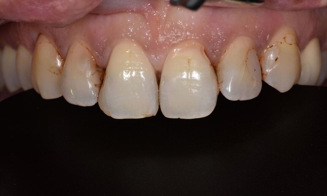 Failing veneers on front teeth before new restorations in toronto
