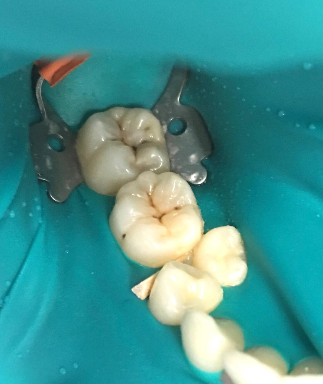 Back teeth before fillings | Dentist Toronto ON