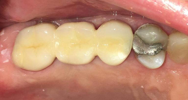 3-Unit-Dental-Bridge-After-Image