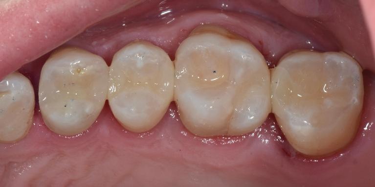 Composite-Tooth-Colour-Restorations-After-Image