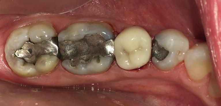 Tooth coloured crown to replace old metal crown