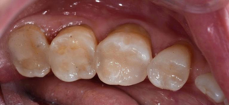 After New white fillings on teeth in etobicoke