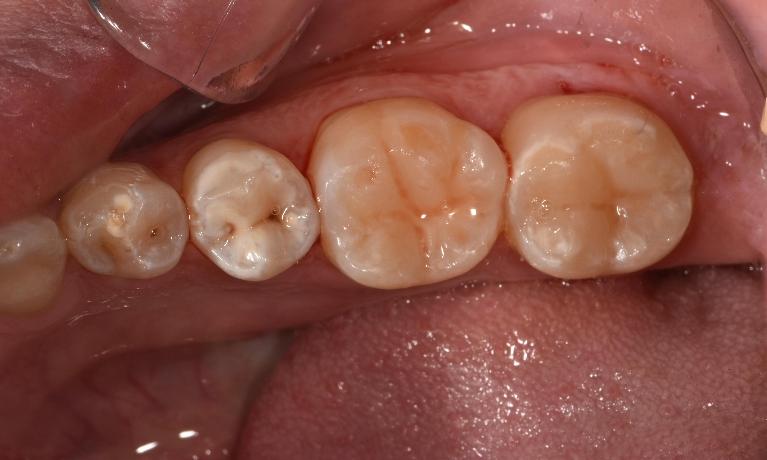Molars after Tooth coloured fillings