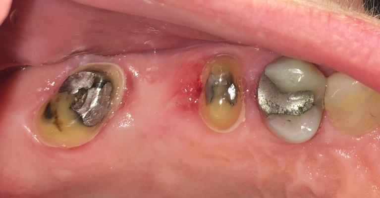 3-Unit-Dental-Bridge-Before-Image