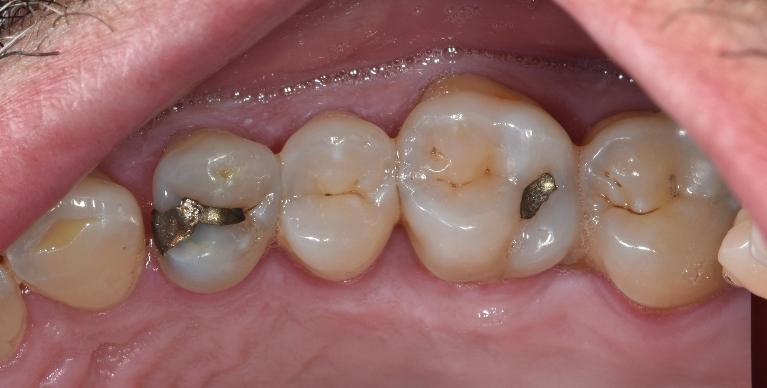 Composite-Tooth-Colour-Restorations-Before-Image