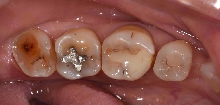 Broken fillings before restoration in etobicoke