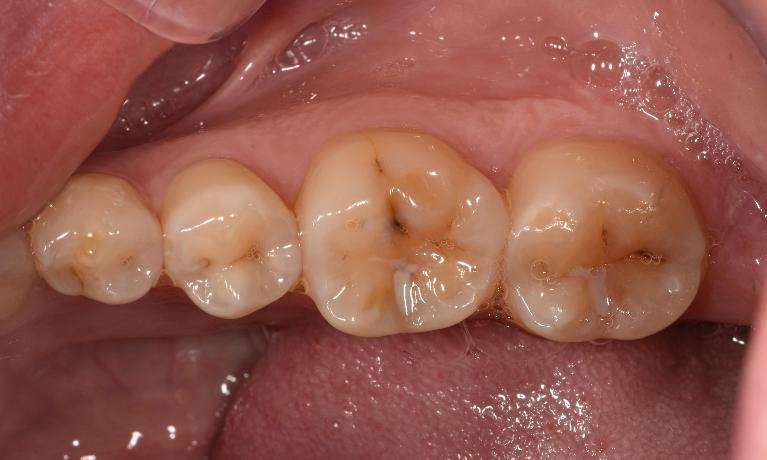 Discoloured grooves in molars before fillings