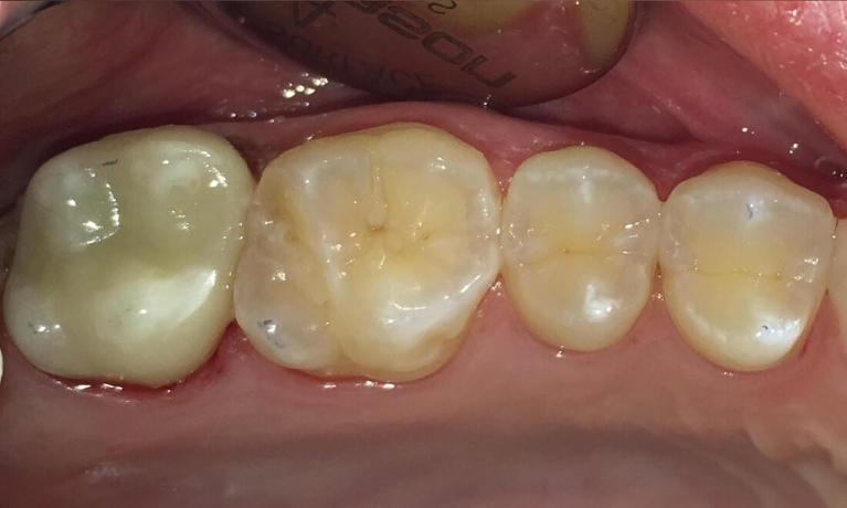 All-Porcelain-Crown-After-Image