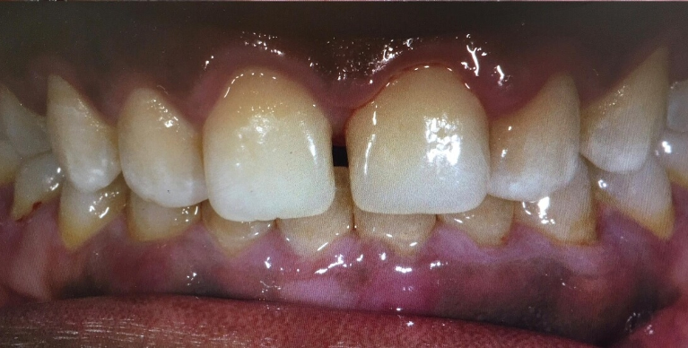after photo of crown lengthening was used on front teeth