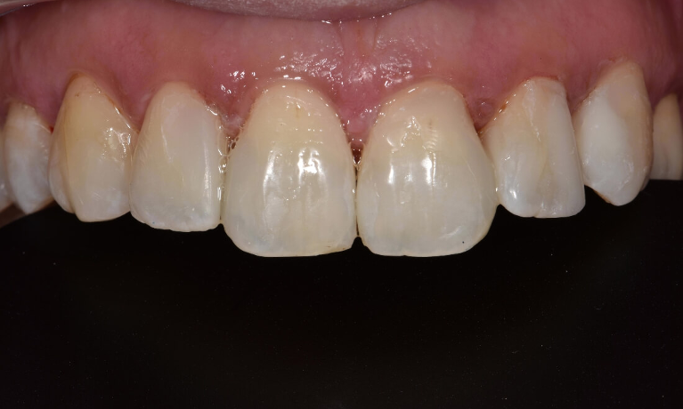 After Front teeth makeover in toronto