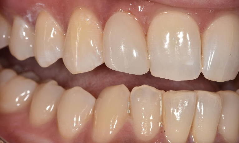 New tooth after veneer