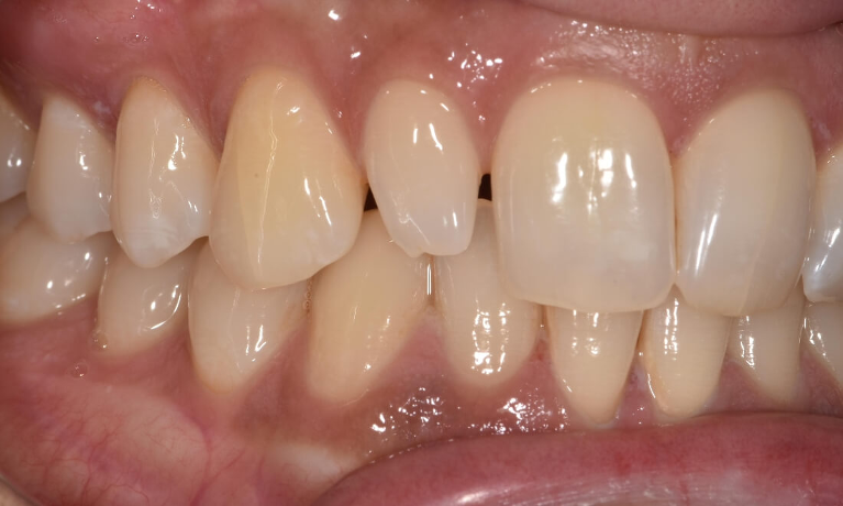 Small tooth before veneer