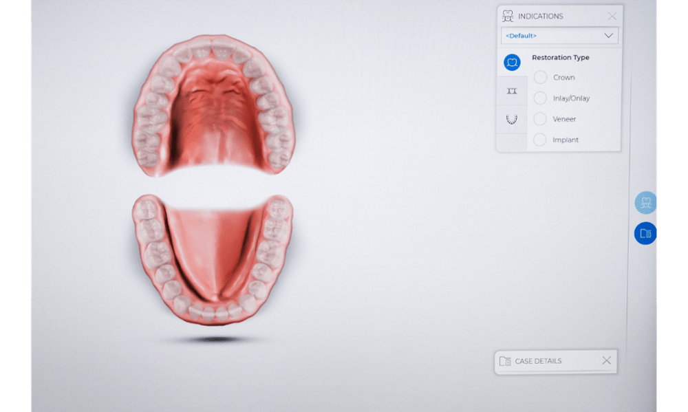 Digital dental model displayed on screen for treatment planning at Toronto Lakeshore Dental