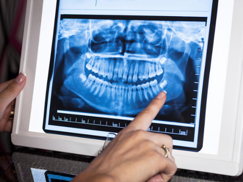 A digital tablet displaying a high-resolution panoramic X-ray of a patient's full upper and lower jaw.