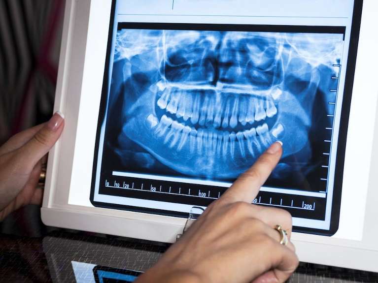 digital dental x-rays
